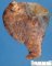 Pulmonary infarct in pulmonary mucormycosis