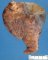 Pulmonary infarct in pulmonary mucormycosis