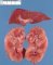 Renal ARPKD