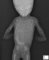 Bilateral radial agenesis with club hands and bilateral thumb agenesis (20 (...)