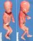 Bilateral radial ray aplasia
