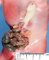 Gastroschisis (Fetus 20 weeks)