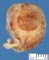Cervical uterine leiomyoma