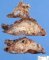 Colonic lymphangioma