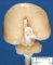 Alobar holoprosencephaly (Case 12063)