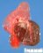 Lymphatic-predominant combined vascular malformation
