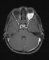 Orbital embryonal rhabdomyosarcoma