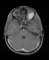 Orbital embryonal rhabdomyosarcoma