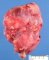 Renal malignant rhabdoid tumor