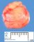 Schwannoma