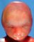 Bilateral cleft lip/palate in trisomy 13