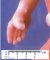 Broad thumb in a Pfeiffer syndrome