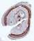 Digestive congenital fibrosarcoma