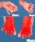 Post-axial polydactyly in Meckel syndrome