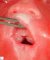 Median cleft palate in polymalformative syndrome