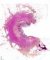 Colonic stenosis in Crohn disease