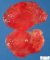 Myxoid liposarcoma