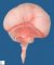 Alobar holoprosencephaly