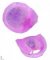 Appendiceal carcinoid tumor
