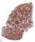 CD20 immunostaining in nodal follicular lymphoid hyperplasia