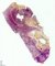 Progressive chronic pulmonary aspergillosis in cystic fibrosis