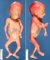 Fetus 20 weeks