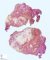 Ossifying myositis