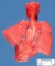 Retroesophageal right subclavian artery in trisomy 21