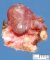 Cyst of the thyroglossal tract