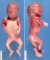 Thick neck in trisomy 21 (fetus 21 weeks)