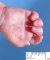 Transverse palmar crease