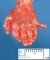 Postaxial polydactyly in trisomy 13