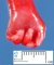 Camptodactyly in trisomy 18