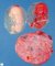 Twin-twin transfusion syndrome