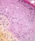 Cutaneous GVH