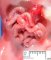 Abdominal wall defects