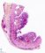 Ileal ulceration in Crohn ileitis