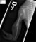 Radial agenesis with ectrodactyly