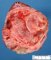 cystic partially differentiated nephroblastoma