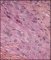 Epithelioid sarcoma