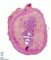 Jejunal atresia in multiple intestinal atresia syndrome