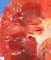 renal Wegener granulomatosis
