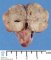 Pericardial teratoma