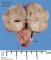 Pericardial teratoma