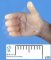 Single transverse palmar crease