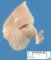 Quadrilobar left lung in trisomy 18 (20 weeks)
