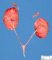Bilateral non-obstructive renal dysplasia (BNORD) in Meckel (...)