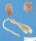 Case 10783: Caudal regression syndrome with rectovaginal fistula