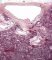 Fetal oligocystic kidneys of unknow cause (case 11389)