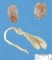Urethral agenesis in urinary agenesis (Case 11443)